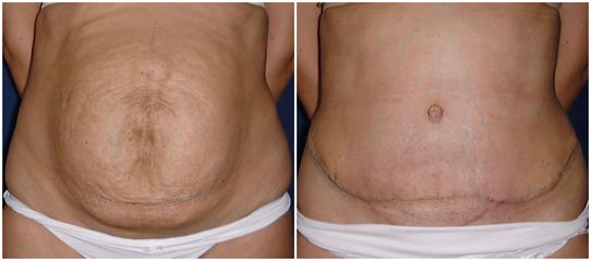 Abdominoplastia - Dr. Albert Vizmanos