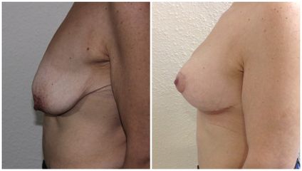 Mastopexia - Dr. Albert Vizmanos