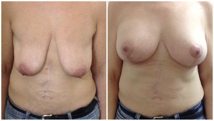Mastopexia - Dr. Albert Vizmanos