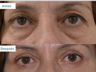 Blefaroplastia - 646197