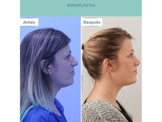 Rinoplastia - 646944