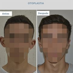 Otoplastia