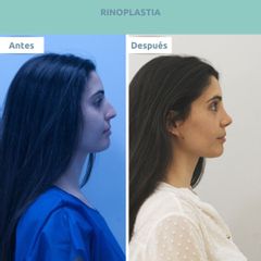 Clínica FEMM - Rinoplastia