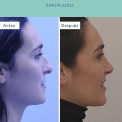 Rinoplastia - Clínica FEMM
