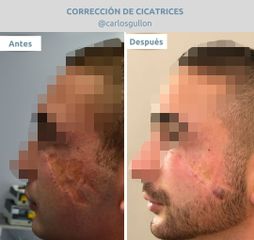 CORRECCION DE CICATRICES DRGULLON.jpg