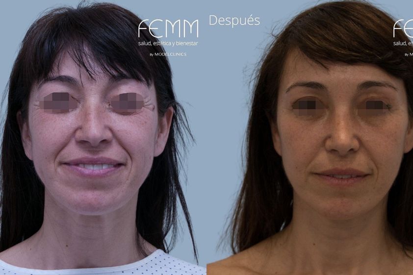 Lipofilling antes y después - 820940