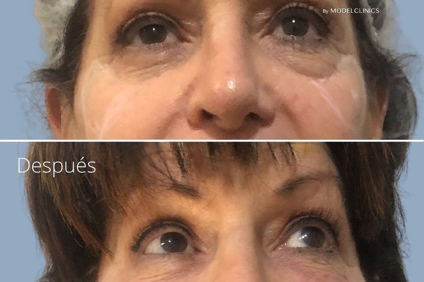 Blefaroplastia sin cirugía antes y después - 843026