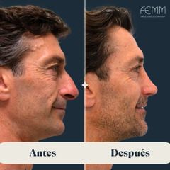 Rinoplastia masculina - Clínica FEMM