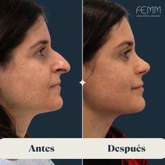 Rinoplastia abierta - Clínica FEMM