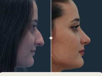 Rinoplastia antes y después - 869107