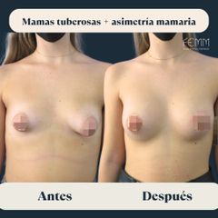 Mamas tuberosas y asimetría mamaria - Clínica FEMM