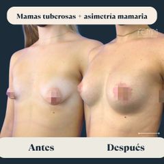 Mamas tuberosas y asimetría mamaria - Clínica FEMM