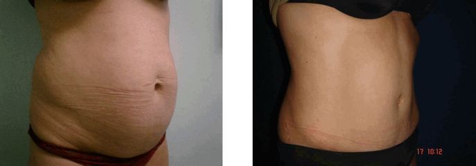 Antes y después Abdominoplastia