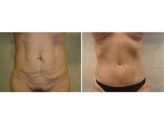 Antes y después Abdominoplastia