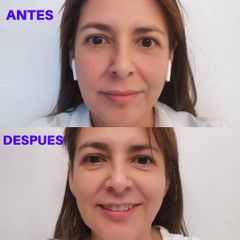 Peeling - Dra. Teresa Pajuelo