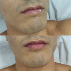 Aumento de labios - Dra. Teresa Pajuelo