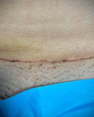 Resultado después de cirugía abierta abdominal - Dr.Rubèn Baltà