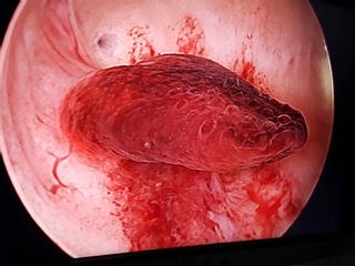 Pólipo endometrial - Cirugía de fertilidad - Dr.Rubèn Baltà