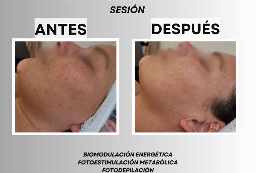 Carboxiterapia antes y después - 863322