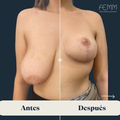 Mastopexia y reducción mamaria - Dra. Eva Lumbreras Marín