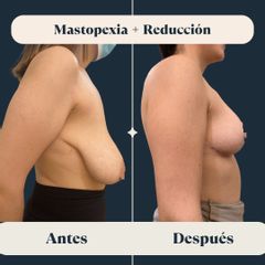 Mastopexia y reducción mamaria - Dra. Eva Lumbreras Marín