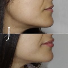 Aumento de labios - Clínica Alejandría
