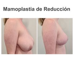 Reducción de senos - Elena García Vilariño