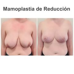 Reducción de senos - Elena García Vilariño