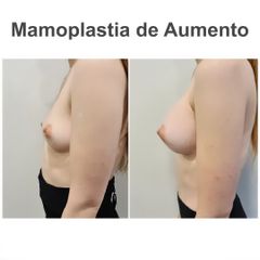Aumento de pecho - Elena García Vilariño