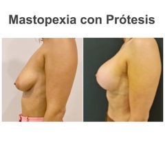 Mastopexia - Elena García Vilariño