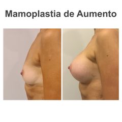 Aumento de pecho - Elena García Vilariño