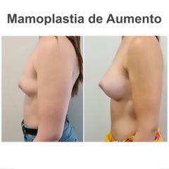 Aumento de pecho - Elena García Vilariño