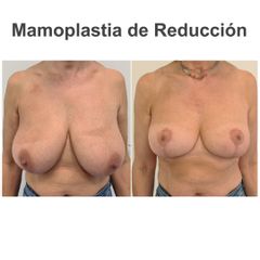 Reducción de senos - Elena García Vilariño