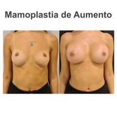 Aumento de pecho - Elena García Vilariño