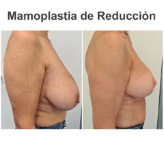 Reducción de senos - Elena García Vilariño