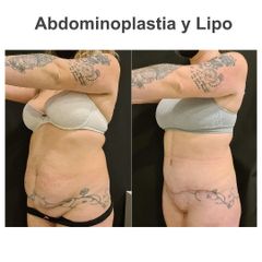 Abdominoplastia - Elena García Vilariño
