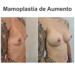 Aumento de pecho - Elena García Vilariño