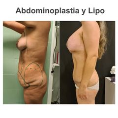 Abdominoplastia - Elena García Vilariño