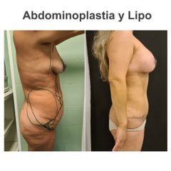 Abdomino y lipo - Elena García Vilariño