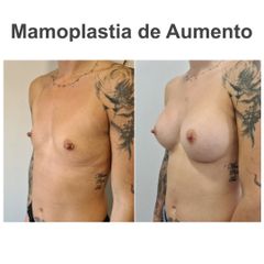 Aumento de pecho - Elena García Vilariño