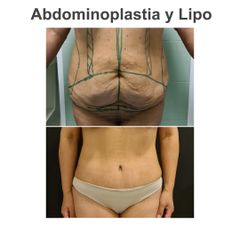 Abdominoplastia - Elena García Vilariño
