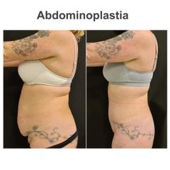 Abdominoplastia - Elena García Vilariño