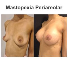 Mastopexia - Elena García Vilariño
