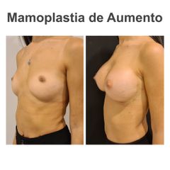 Aumento de pecho - Elena García Vilariño