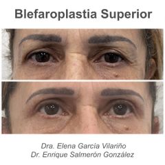 Blefaroplatsia - Dra Elena Garcia Vilariño