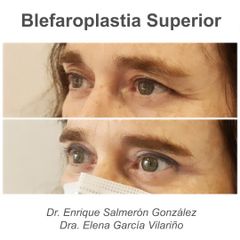 Blefaroplastia - Dra Elena Garcia Vilariño