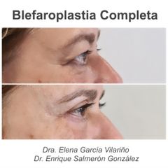 Blefaroplastia - Dra Elena Garcia Vilariño