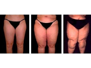Antes y después Liposucción 