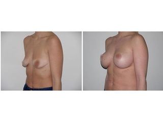 Antes y después Mastopexia