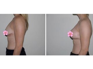 Antes y después Mastopexia